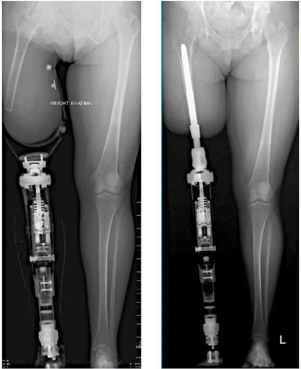 Zestawienie RTG: proteza z lejem po lewej i mocowanie protezy do implantu w kości udowej po prawej